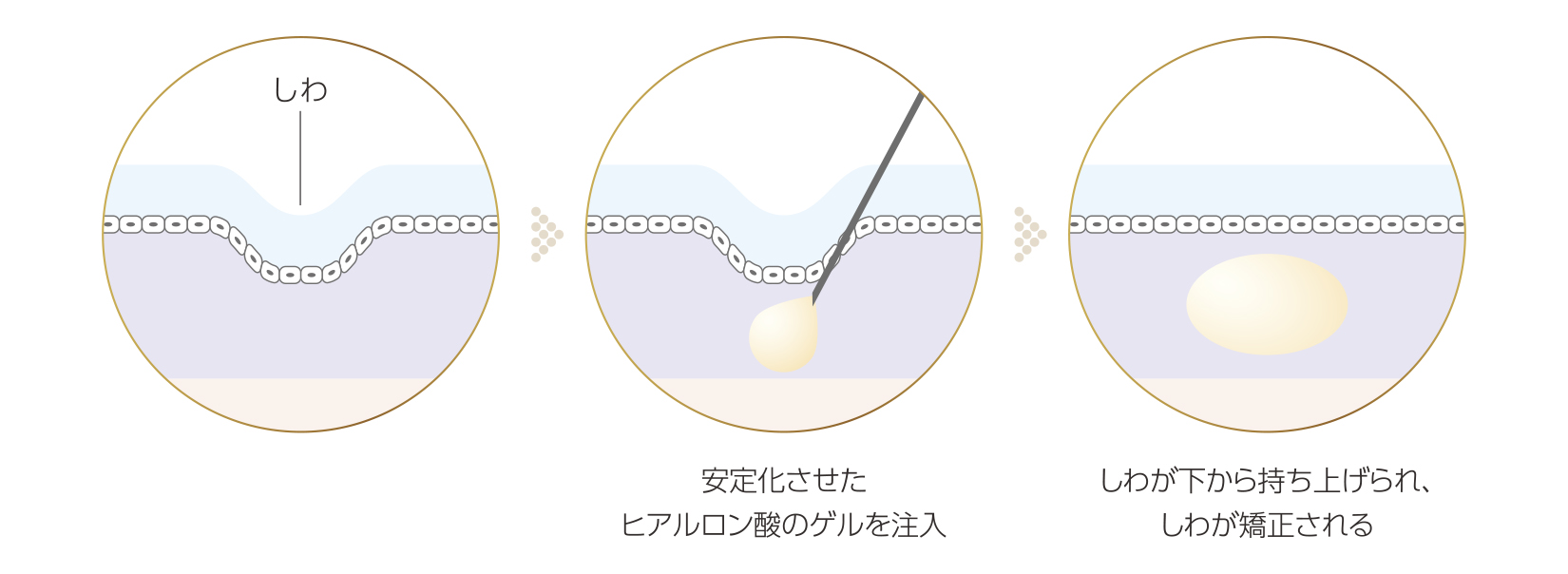 ヒアルロン酸